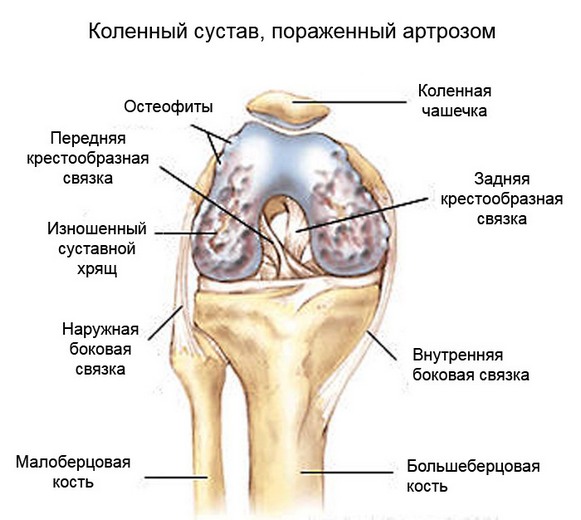 Изменнения при артрозе коленного сустава