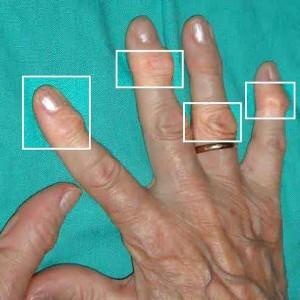 Полиостеоартроз кистей рук